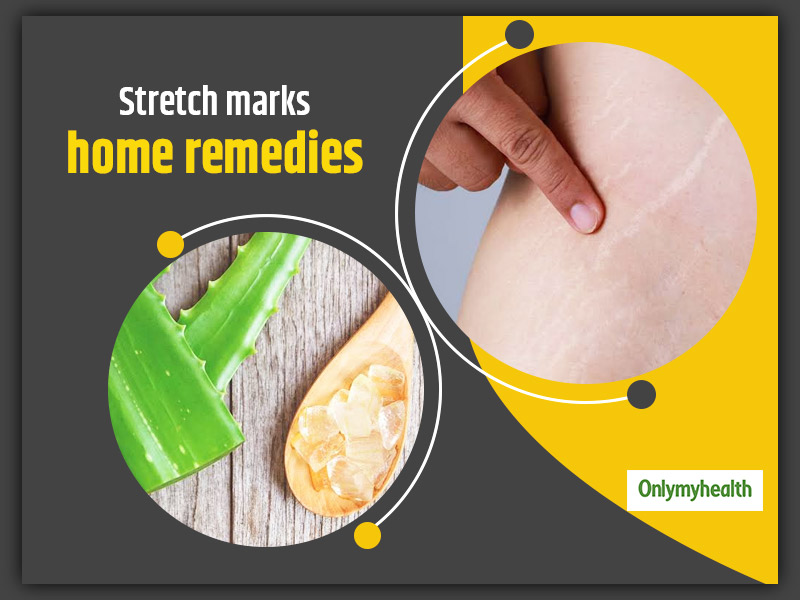 Try These 10 Impressive Home Remedies To Reduce Stretch Marks Naturally 